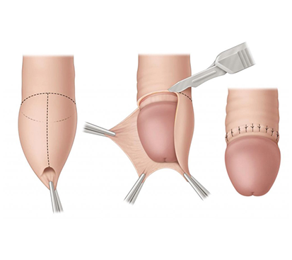 Paraphimosis Surgery in Kolathur