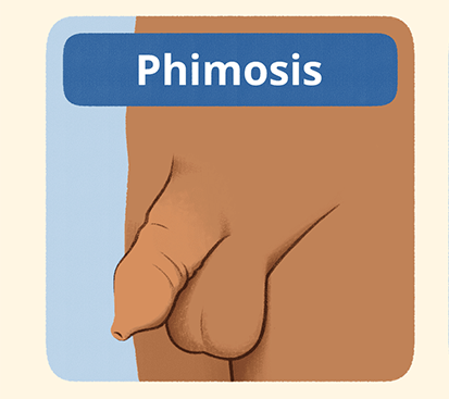 Foreskin Infection Treatment Cost in Mogappair