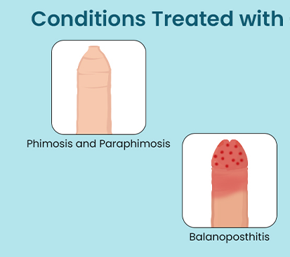 Tight Foreskin Surgery in Kolathur