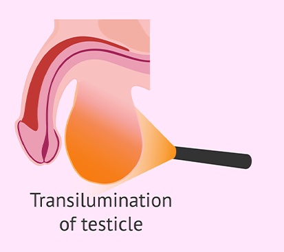 Phimosis Surgery in Mogappair