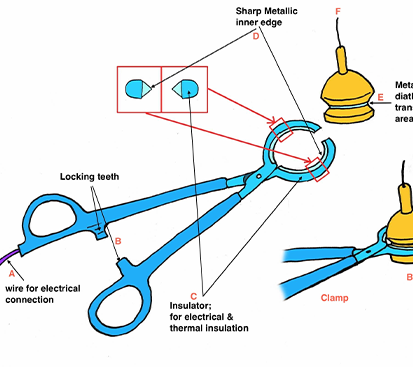 Foreskin Removal surgery in Mogappair