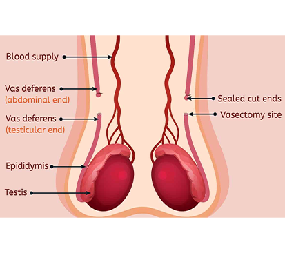 Vasectomy Surgery in Mogappair