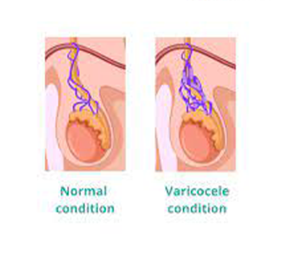 Varicocele Treatment in Kolathur