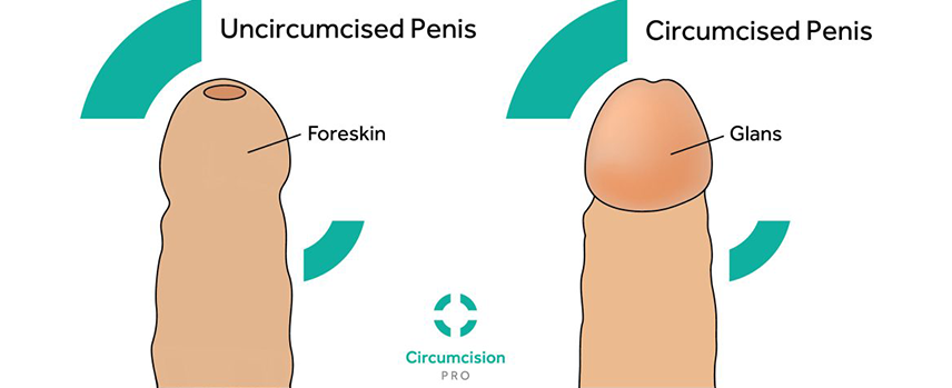 Paraphimosis Treatment in Mogappair