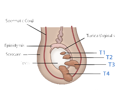 Foreskin Infection Treatment in Kolathur
