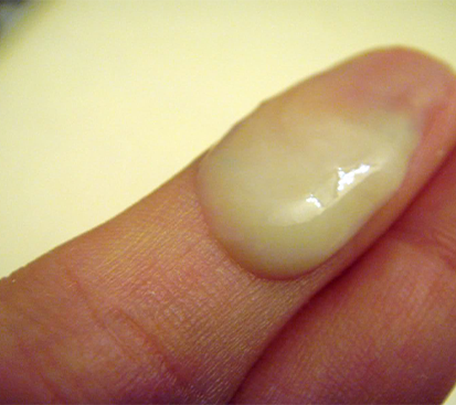 Swollen Penis Treatment in Mogappair