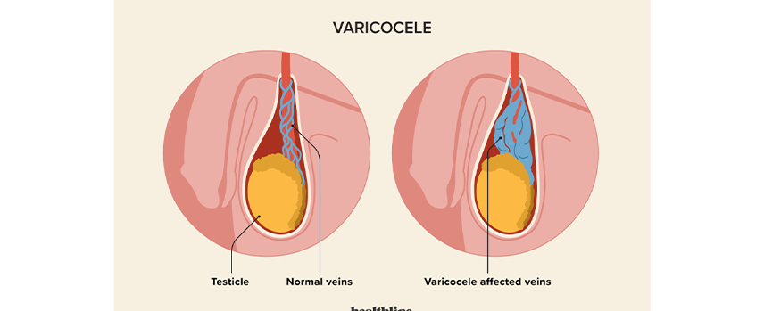 Varicocele Treatment in Mogappair