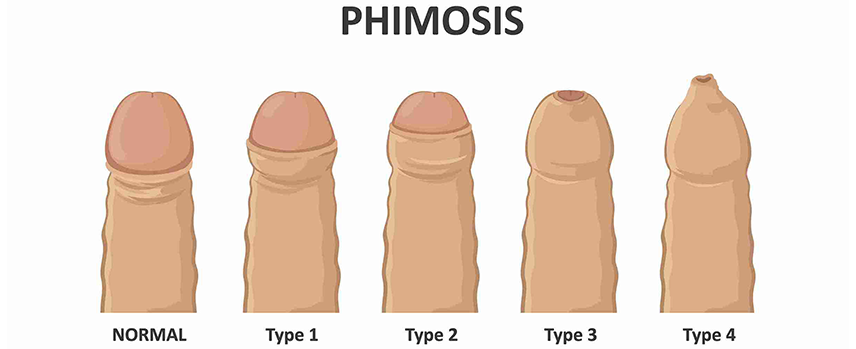 Foreskin Infection Treatment in Mogappair