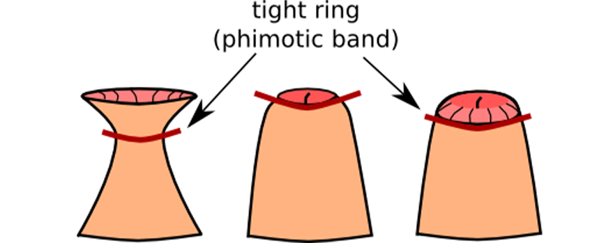 Tight Foreskin Treatment in Kolathur