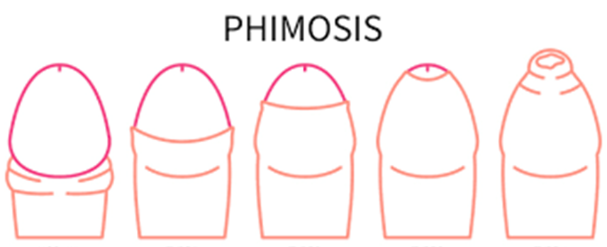 Phimosis Treatment in Kolathur