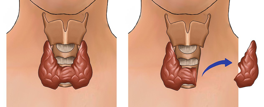 Thyroidectomy Surgery in Kolathur