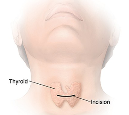 Thyroidectomy Surgery in Mogappair