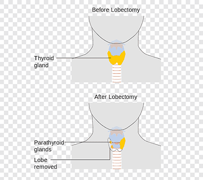 Thyroidectomy Treatment in Kolathur
