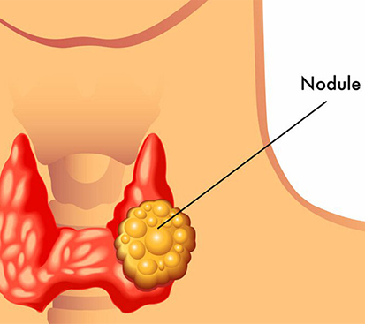 Thyroid Nodule Surgery in Mogappair