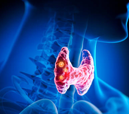 Thyroid Nodule Treatment in Kolathur