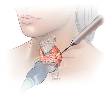Thyroid Nodule Treatment in Mogappair