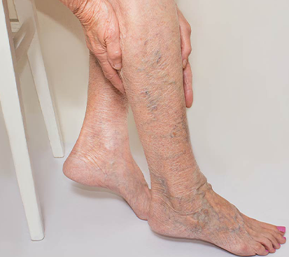 Varicose Veins Treatment in Kolathur