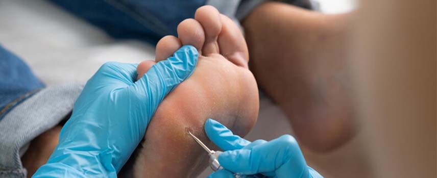 Wart Removal Treatment in Kolathur