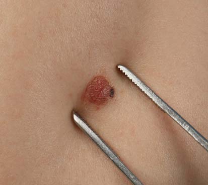 Wart Removal Treatment in Mogappair